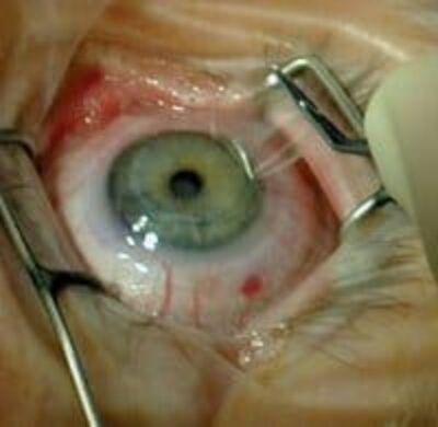 I Can See! I Can See! Better than Ever