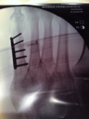 The plate and the five screws in my fifth metatarsal bone of my left foot.