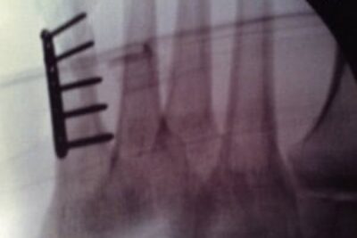 The plate and the five screws in my fifth metatarsal bone of my left foot.