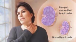 The Lymphoma Inside Me